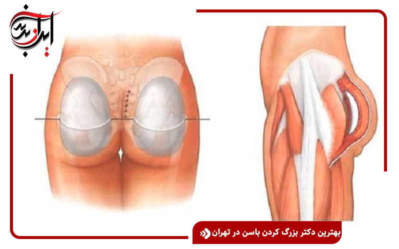 بهترین دکتر بزرگ کردن باسن در تهران