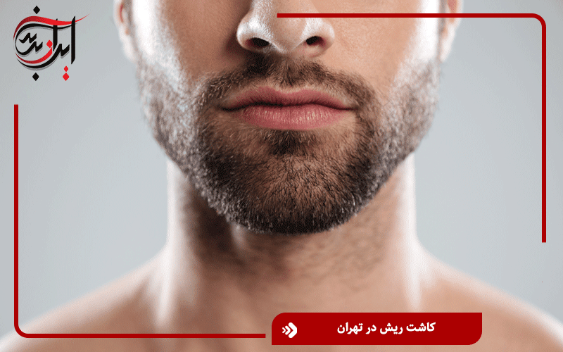 کاشت ریش در تهران