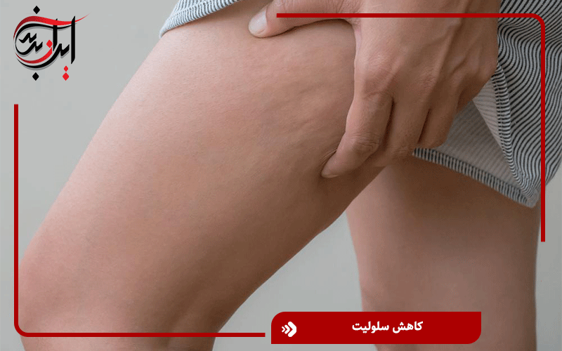 کاهش سلولیت