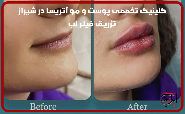 نمونه-کار-تزریق-فیلر-لب-در-کلینیک-تخصصی-پوست-و-مو-اتریسا-در-شیراز