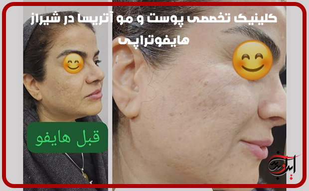 نمونه-کار-هایفوتراپی-در-کلینیک-تخصصی-پوست-اتریسا-در-شیراز