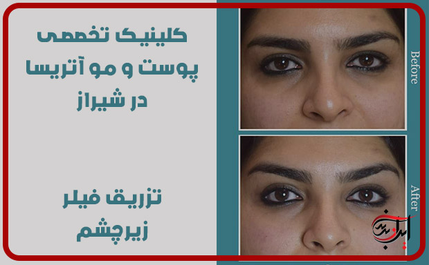 تزریق-فیلر-زیر-چشم-در-کلینیک-پوست-و-مو-اتریسا-شیراز